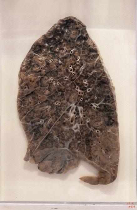 From the 1918 influenza pandemic, a pneumonia-ridden lung at the National Museum of Health and Medicine in Silver Spring, Maryland. 