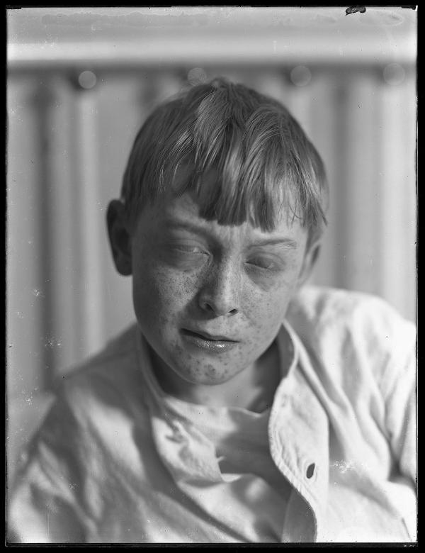 William Gray Hassler with measles, circa 1913